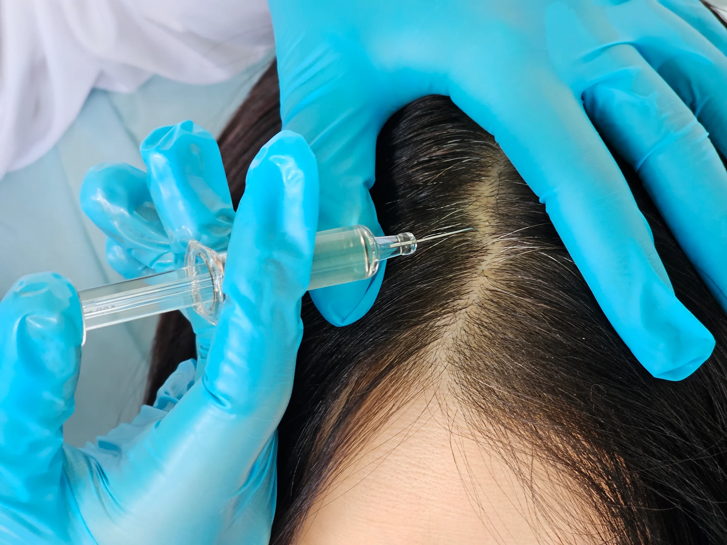 Scalp treatment session in a modern clinic with a focus on hair restoration techniques and professional application
